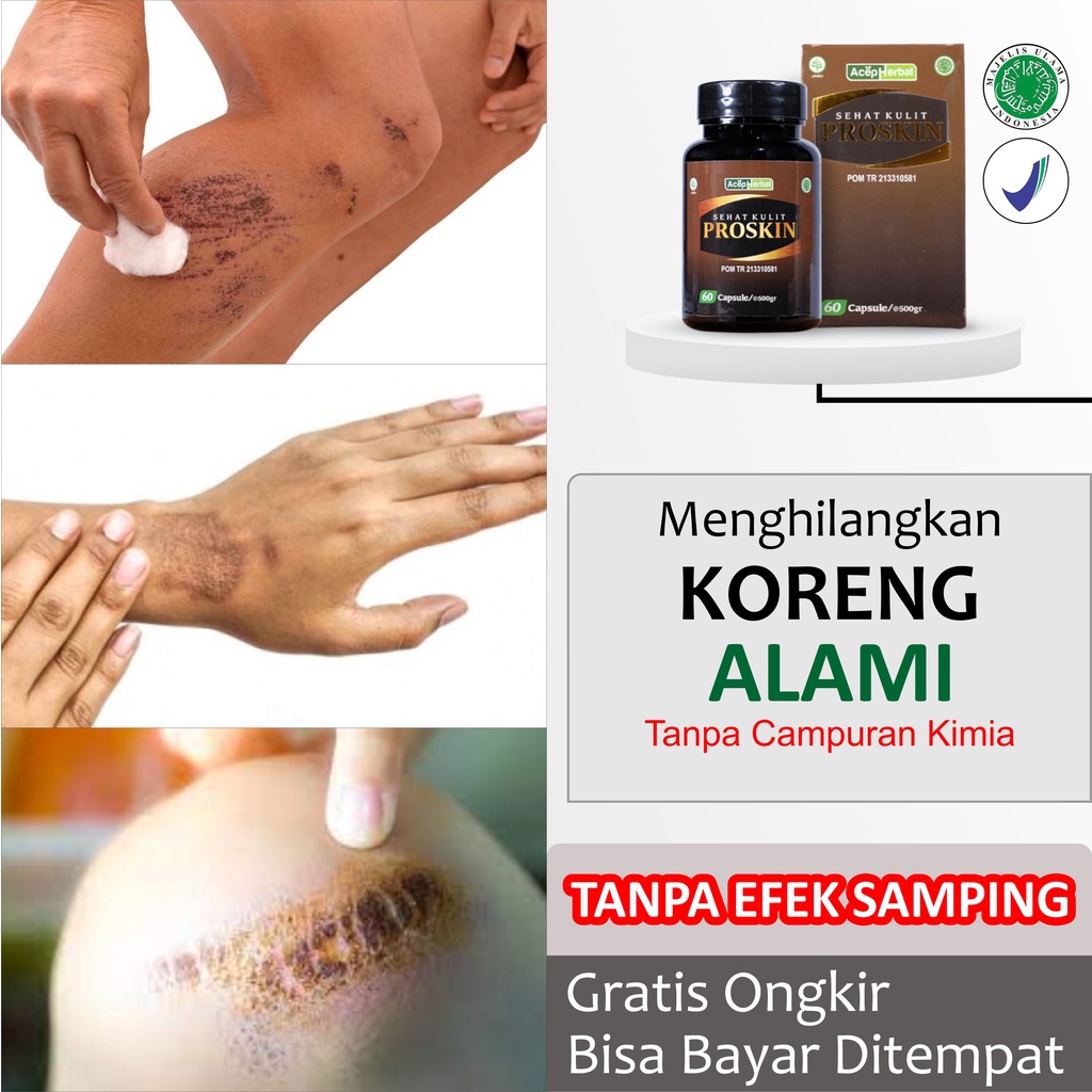 Penghilang Bekas Luka Koreng Borok Bernanah Paling Alami untuk Menghilangkan Korengan Scabies Manusia Gatal di Kaki Tangan Selangkangan Pantat Menahun Gudik Budug Obat Kapsul Oles Herbal Ekstrak Daun Binahong PROSKIN Original BPOM Non Salep Cina Cream