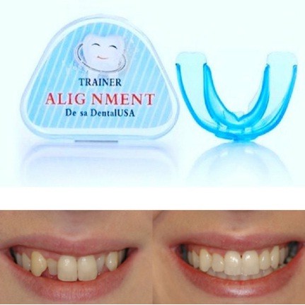 [BIRU] Perapi Gigi Tanpa Behel dari Bahan Silikon Bukan Kawat l Orthodentic Retainer Teeth Phase 1