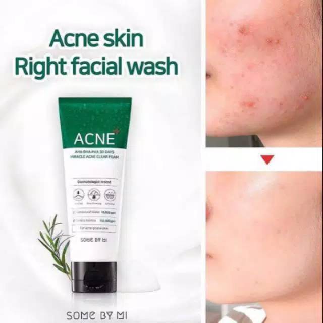 SOMEBYMI Miracle ACNE CLEAR FOAM AHA BHA PHA 30 days some by mi facial