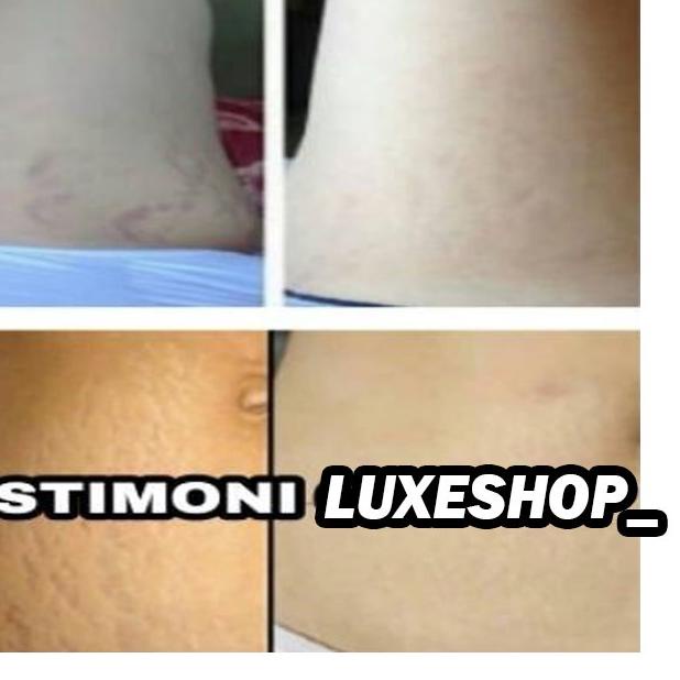 ➧ Cream Penghilang Stretch Mark Krim Penghilang Selulit Krim Penghilang Stretch Mark Penghilang Kelo