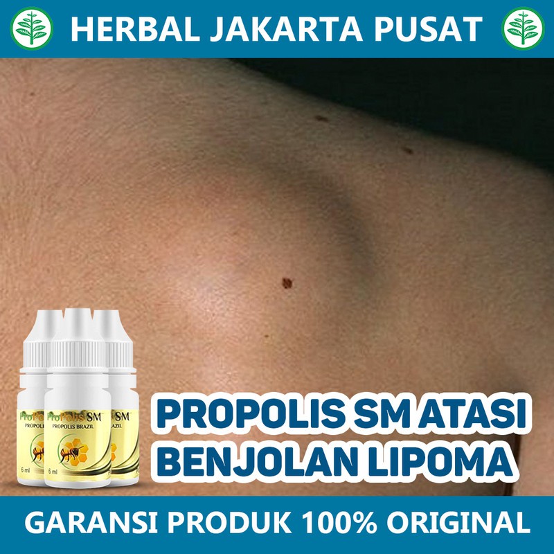 Jual Obat Benjolan Lipoma Penghancur Lipoma Benjolan Lemak Di Leher