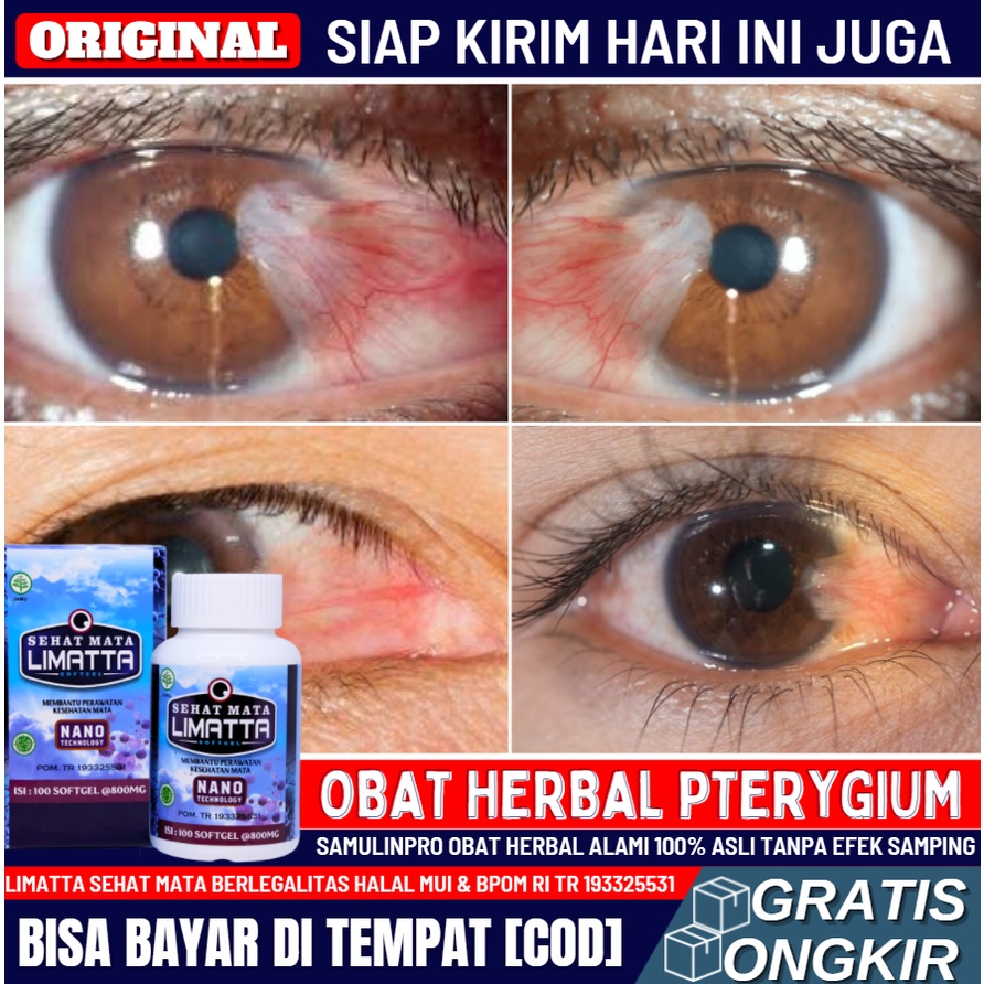 Obat Herbal Penghilang Mata Berlemak 100% ASLI Alami, Obat Penyakit Mata Pterygium Untuk Anak & Dewa
