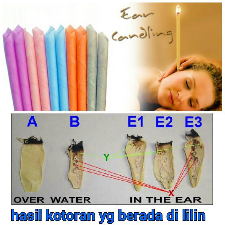 ear candle / lilin telinga / lilin terapi telinga
