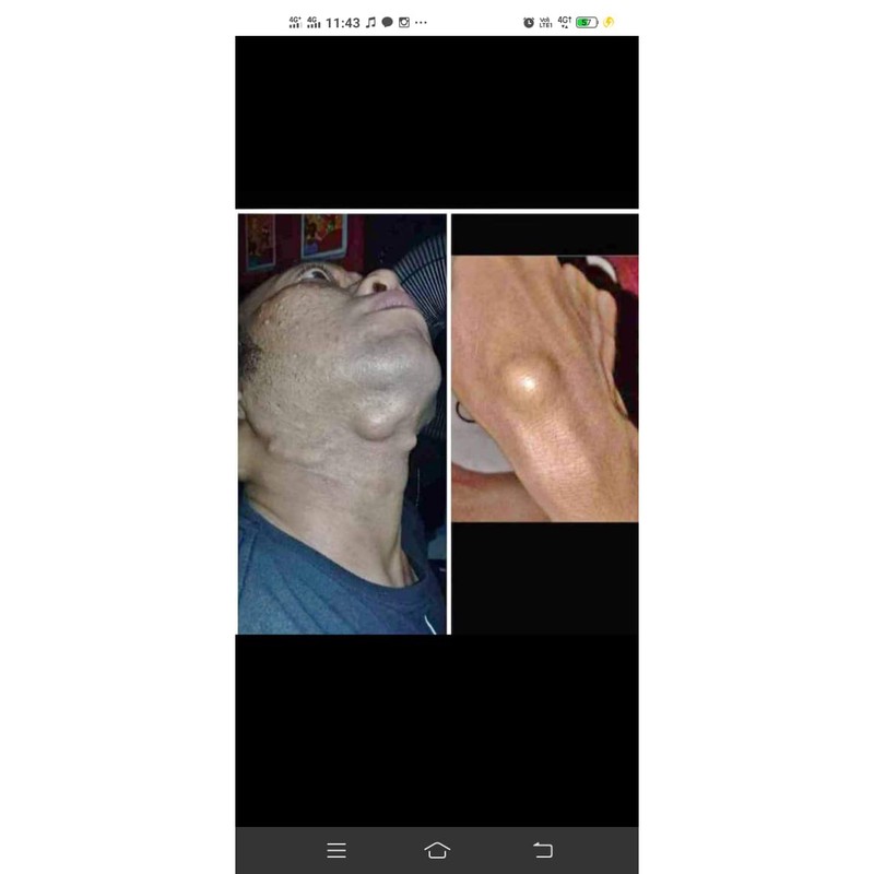 PENGHILANG BENJOLAN, BEKAS LUKA DAN KORENG HERBAL ALAMI