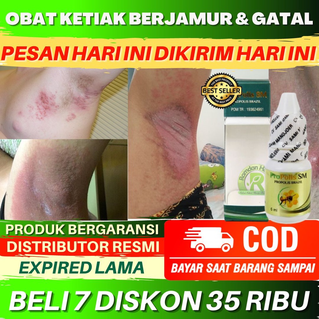 Obat Ketiak Berjamur Infeksi Jamur di Ketiak Kulit Ketiak Gatal Obat Benjolan Di Ketiak Obat Ketiak 
