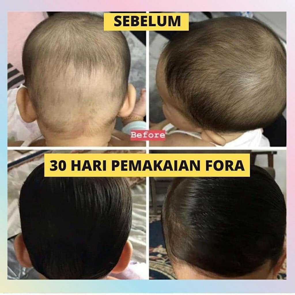 MINYAK RAMBUT KEMIRI Plus Jojoba Oil FORA Cap Ibu dan Anak BPOM: NA18191005486 Untuk Penumbuh dan Penyubur Rambut Bayi dan Dewasa