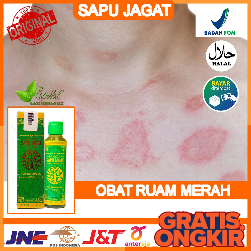 Jual Obat Ruam Merah Bentol Bentol Biang Keringat Gatal Gatal Minyak Sapu Jagat Di Bali 4635