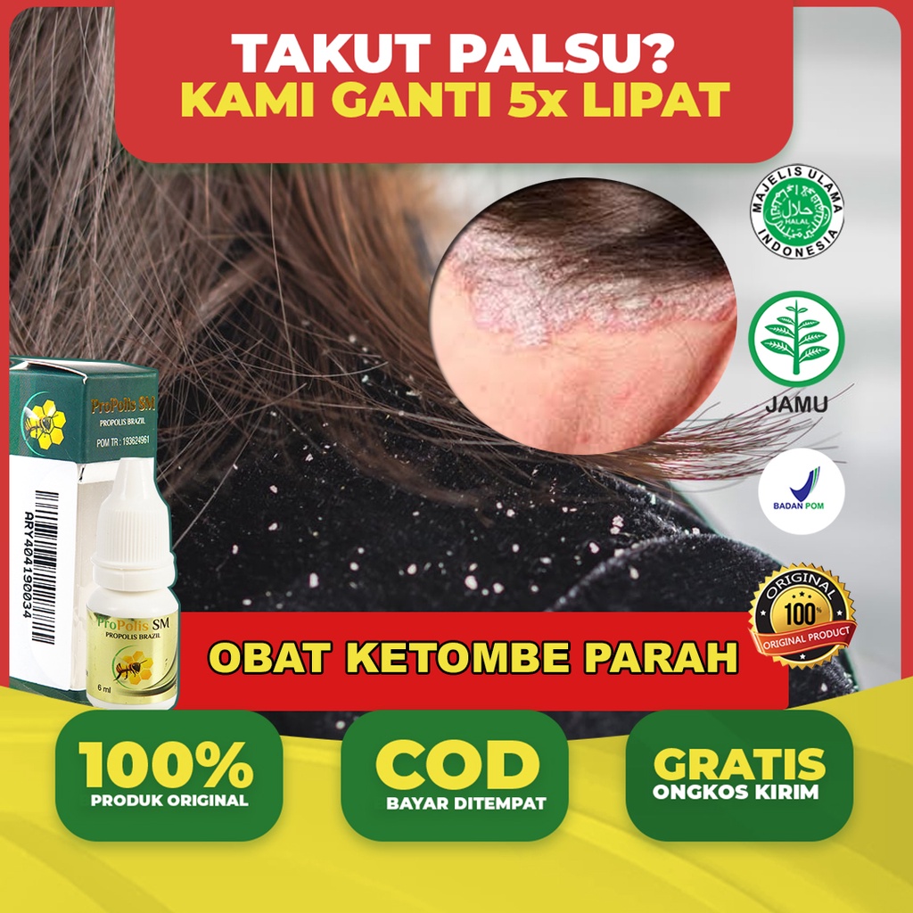 Obat Ketombe Parah - Gatal Kulit Kepala - Kulit Kepala Berkerak - Kepala Kering Bersisik - Benjolan 