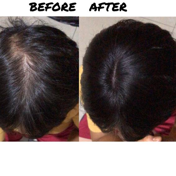 NEW ARRIVAL  9.9 Skin Toupee human Hair / Tempelan penutup botak rambut asli rambut palsu wig wanita human hairclip [KODE 792]