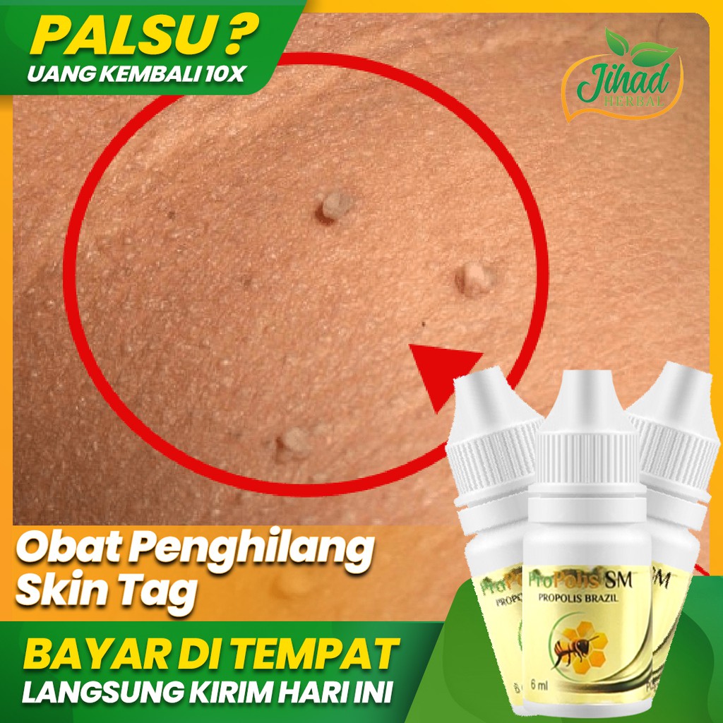 Obat Herbal Penghilang Skin Tag, Kutil Skin Tag Walatra Propolis Brazil