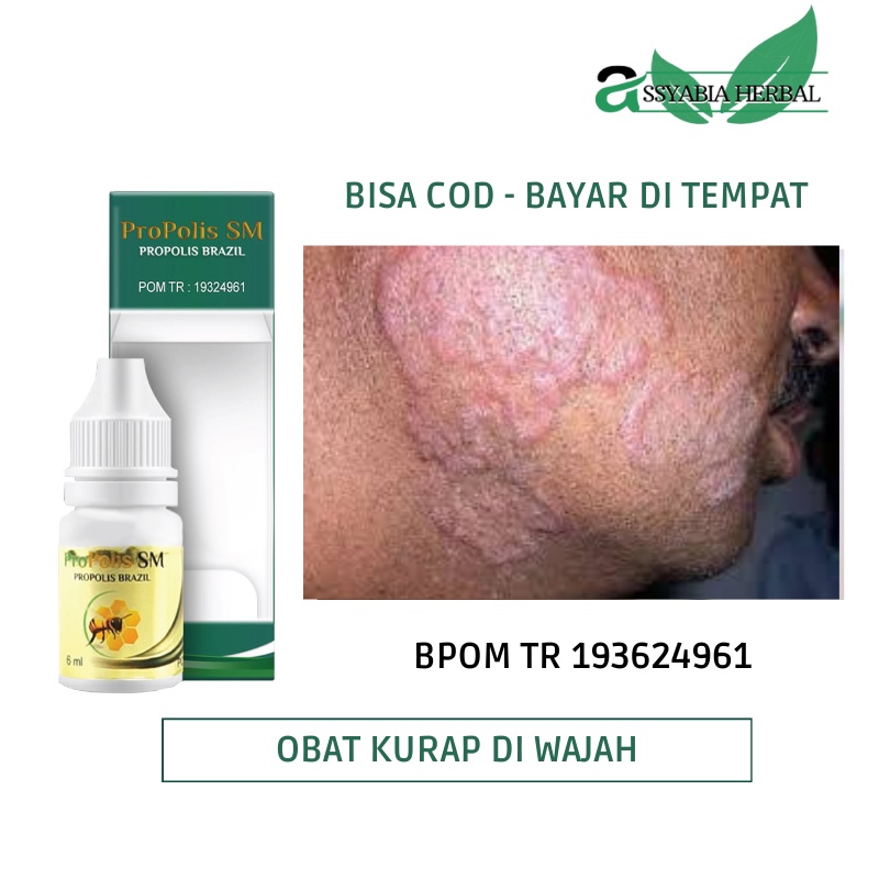 Obat Kurap di Wajah, Penghilang Kurap & Kudis, Tinea Fasialis, Ringworm, Ruam Melingkar - Propoli sm