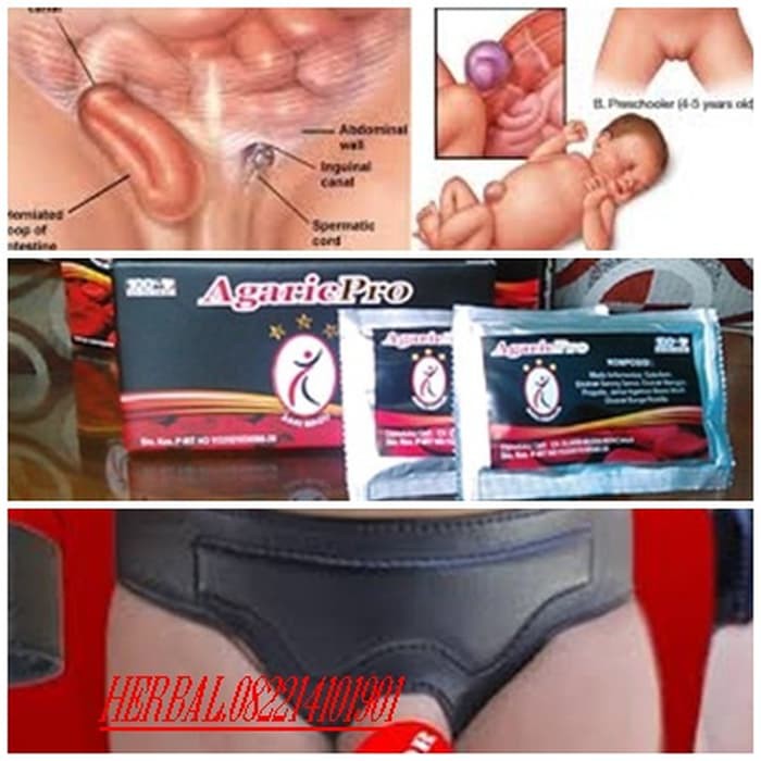 Pengobatan Hernia Anak Bayi Balita Dengan Agaricpro + Celana Hernia