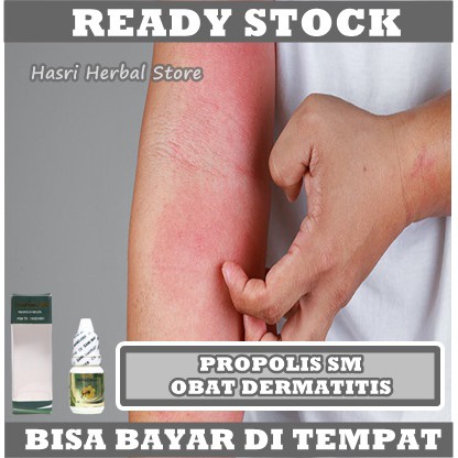 Obat Dermatitis, Dermatitis Atopik, Dermatitis Seboroik, Dermatitis Kontak, Gatal Dermatitis - Propolis SM