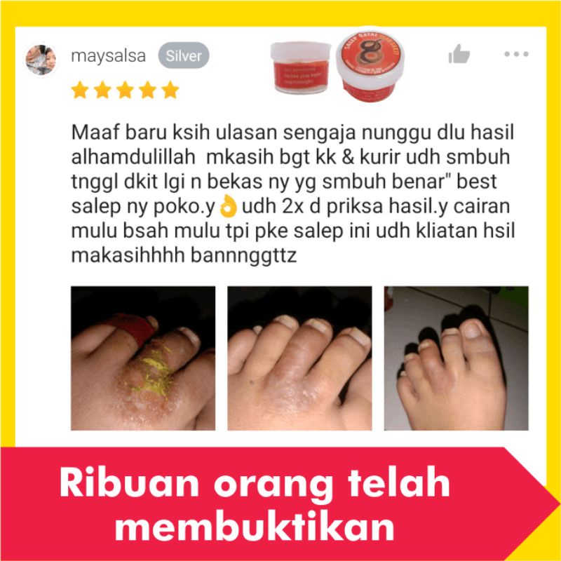Salep Obat Kurap Kudis Paling Ampuh Gatal Kulit Gatel Kadas Eksim Kering Kutu Air Jamur Selangkangan-1