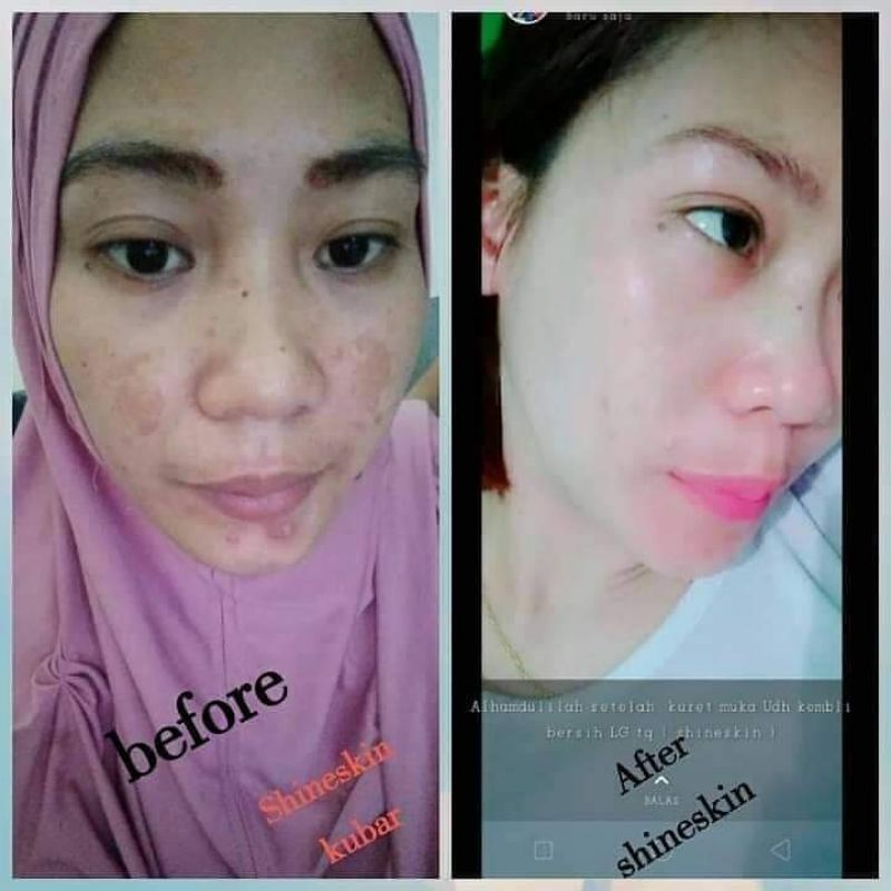 PAKETAN FLEK HITAM SHINESKIN SKINCARE