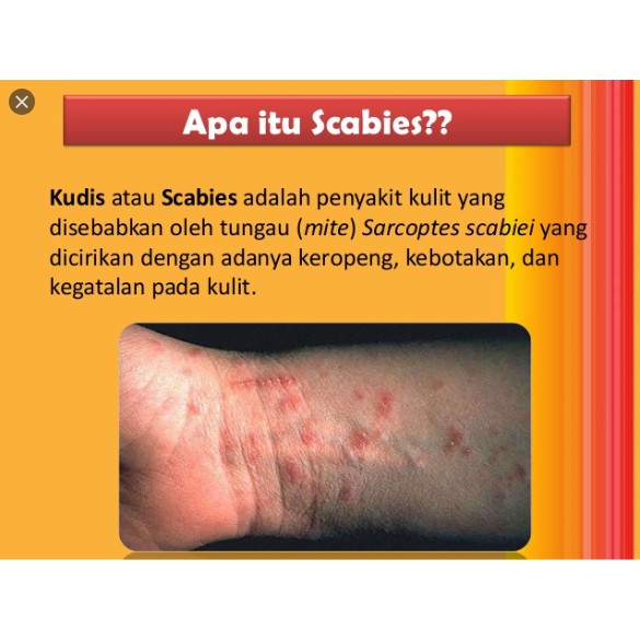 Cod Salep Gatal Obat Scabies Salep Scabies Obat Kudis Obat Gudik Obat Kulit Gatal Permethrin Shopee Indonesia