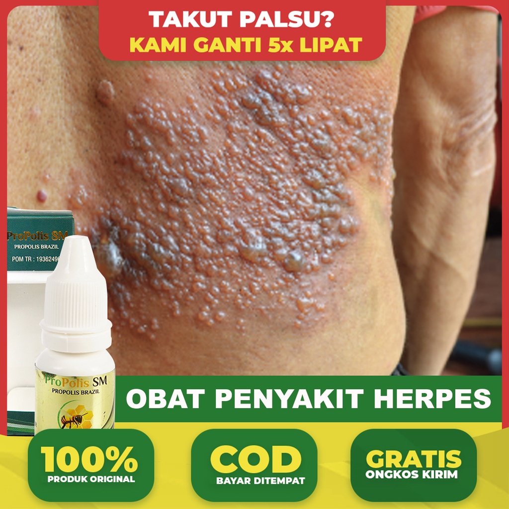 Obat  Herpes - Gatal Gatal - Jamur - Kurap - Kulit Kepala Bersisik - Kulit Kepala Gatal Parah - Kura