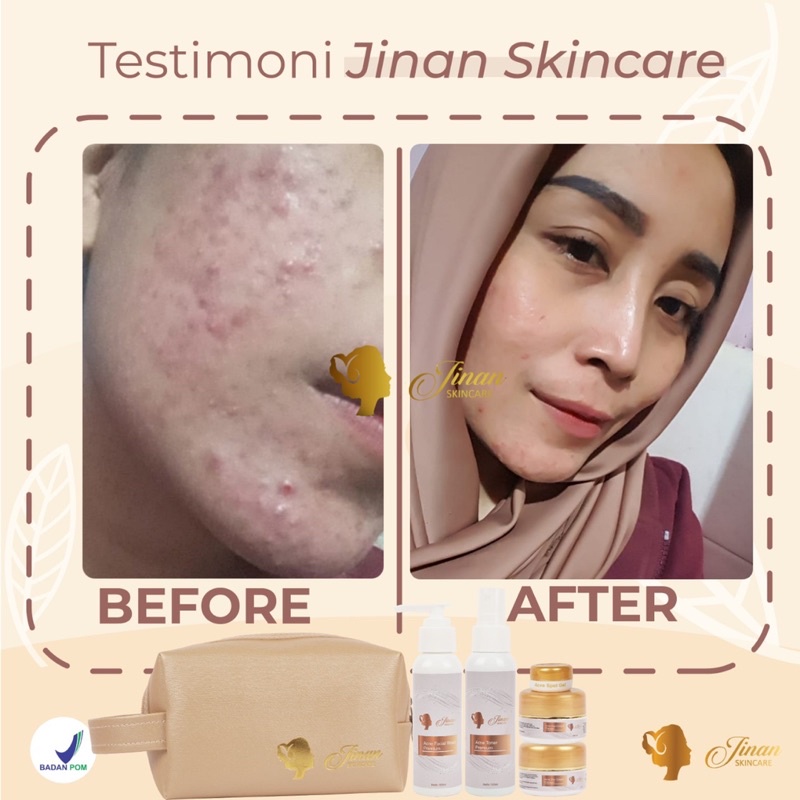 Paket Acne Jinan Skincare || Free Acne Spot Gell