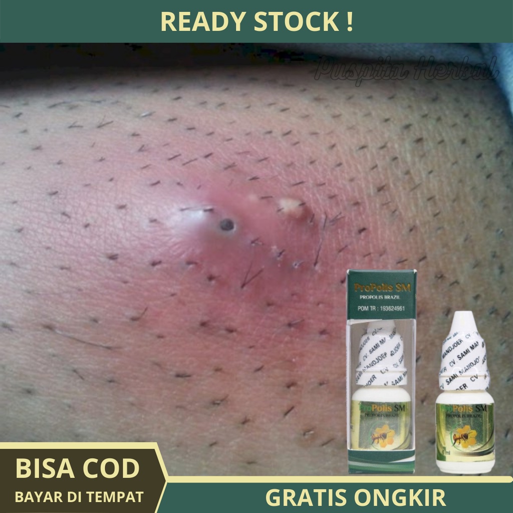 Obat Bisul Di Pantat, Obat Bisul Bernanah, Obat Bisul Anak, Obat Bisul Pada Kelamin, Obat Bisul Berd