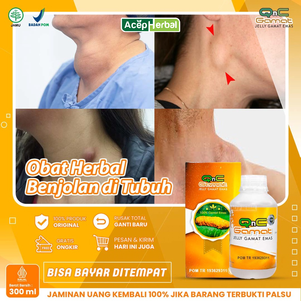 Jual Obat Benjolan di Leher Kelenjar Getah Bening Lipoma Uci-Uci