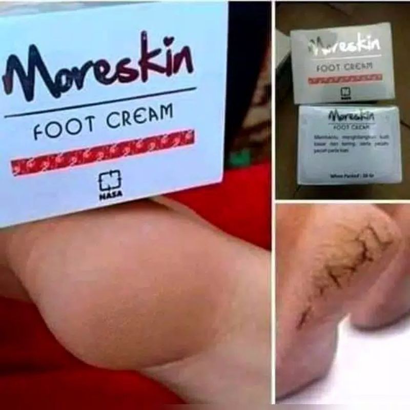 Kaki pecah dan kering - Moreskin foot cream - Obat kaki pecah2 - Obat kaki Pecah dan kering