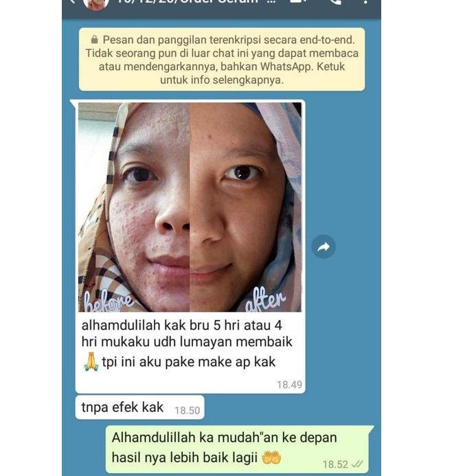 ♚ ADERA FACE SERUM ORIGINAL SERUM ADERA WAJAH ORI UNTUK FLEK HITAM GLOWING ORI ASLI 100% ➤