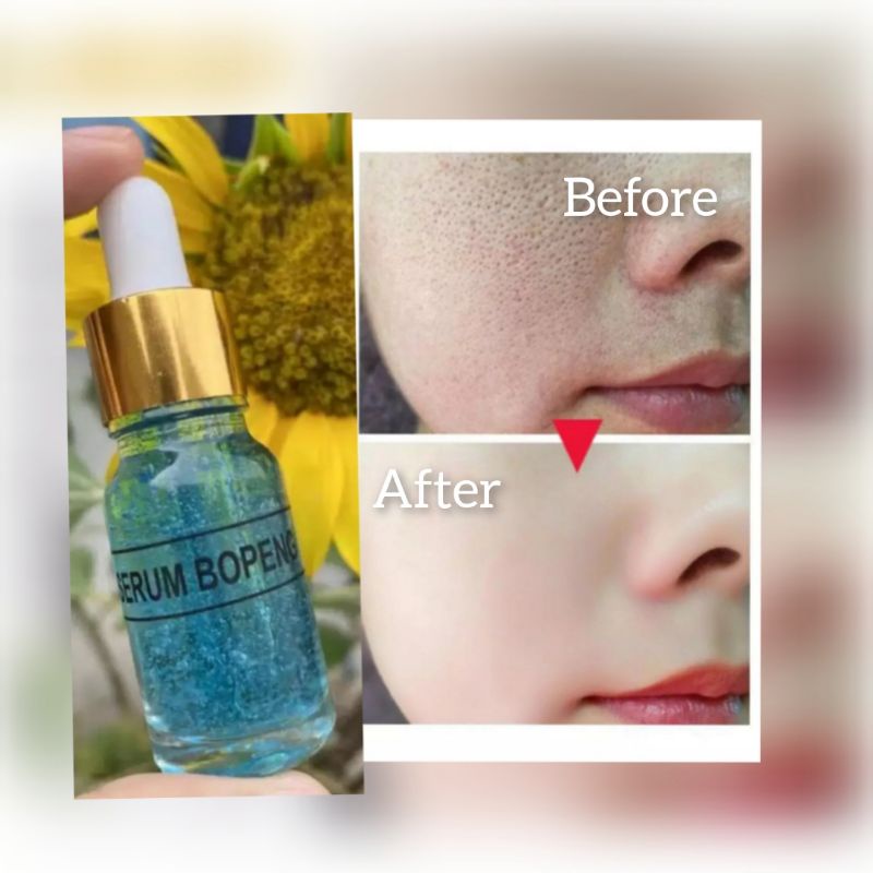 SERUM BOPENG/BEKAS JERAWAT TERBUKTI AMPUH 10ML