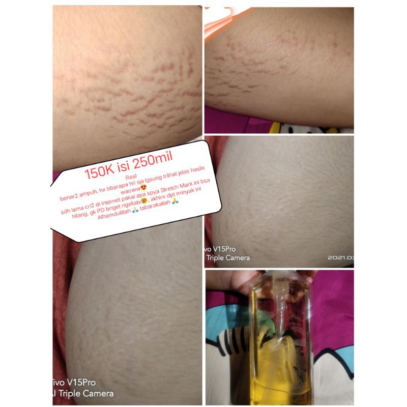 Penghilang stretch mark / ampuh menghilangkan stretch mark / minyak strech mark / strech mark oil