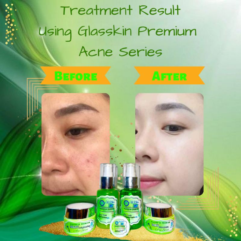 ACNE SERIES GLASSKIN PREMIUM SKINCARE PERAWATAN PEMUTIH WAJAH GLOWING JERAWAT FLEK ALESKIN GLOW