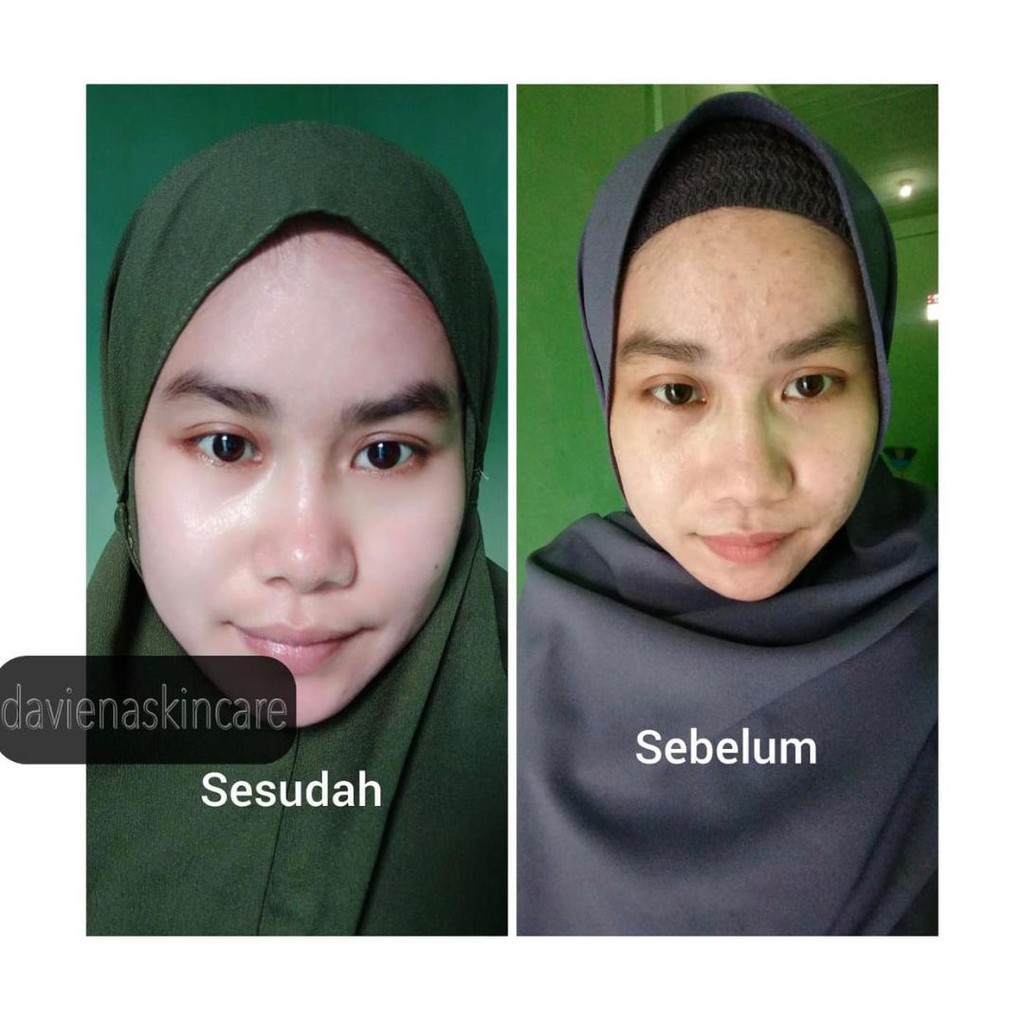 BEST DAVIENA SKINCARE PAKET HEMAT ACNE 1 (ACNE GEL | DAVIENA | DAVIENA SKINCARE | DAVIENASKINCARE Davina ASLI 100% Krim Cream Wajah Mengatasi Jerawat Bekas Jerawat Bopeng Pori Pori Besar FLEK Noda Hitam Kulit Kusam Jadi Glowing dan Sehat OFFICIAL ORIGINAL