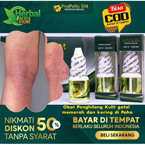 Obat Penghilang Kulit gatal, memerah dan kering di Paha | Salep Herbal Oles Mengurangi Gatal Gatel A