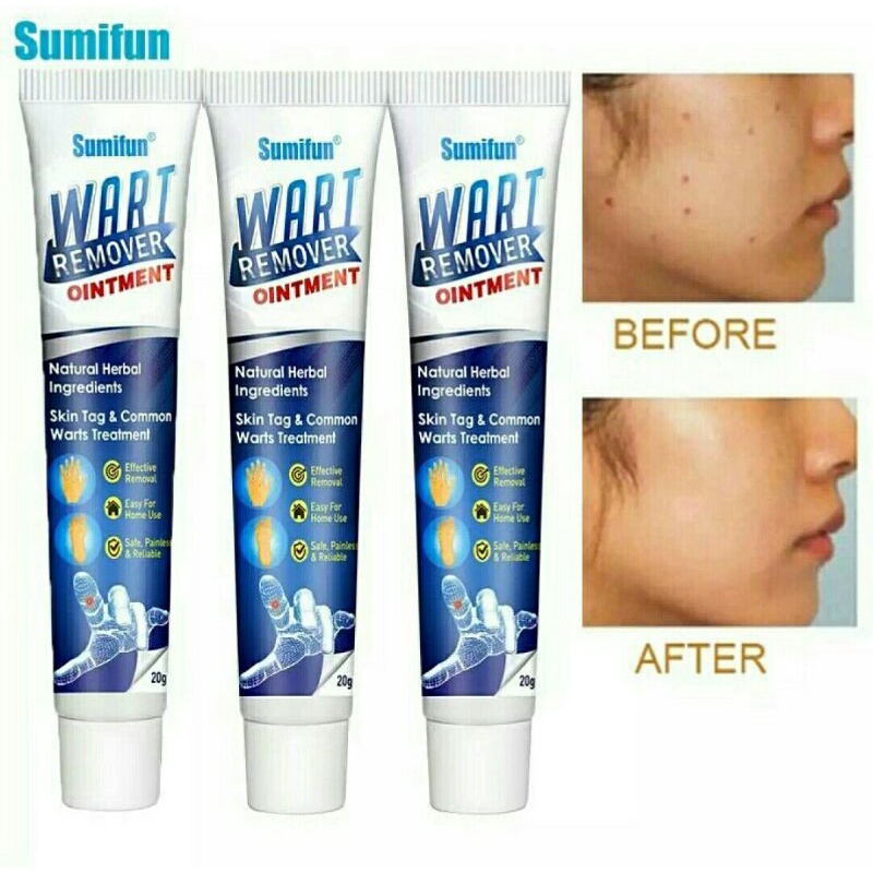 AD Skin tag Remover Krim Penghilang Kutil