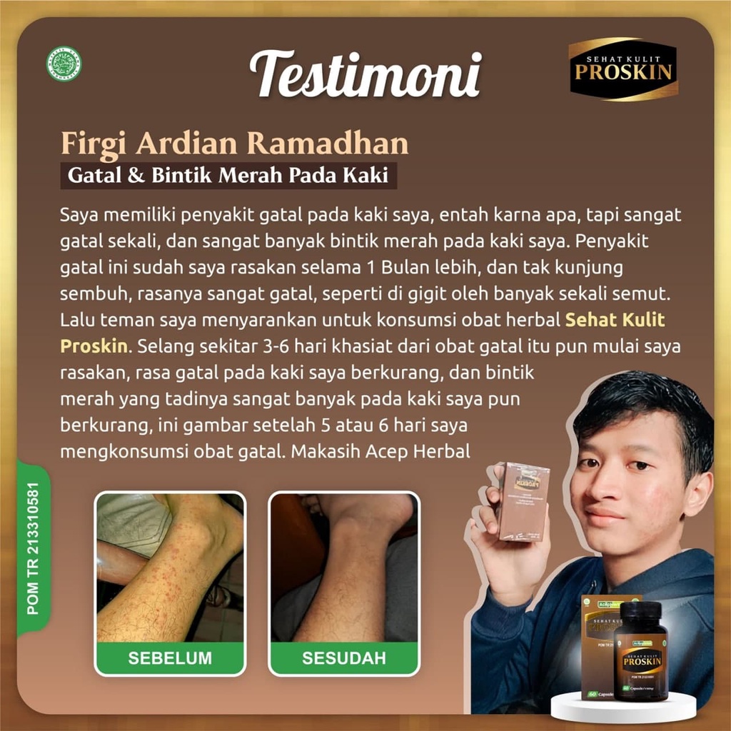 Obat Gatal Selangkangan Gatel Jamur Kulit Selangkangan Hitam Gatal2 Kurap Eksim Borok Scabies Manusia Herbal Pembersih Selangkangan Bokong Menghitam Paling Alami Herbal Ekstrak Daun Binahong PROSKIN BPOM Tanpa Efek Samping Salep Cream Balm Krim Cina-6