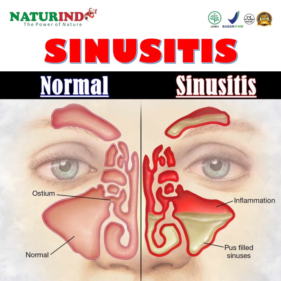 Obat Sinusitis Polip Hidung Radang Pada Hidung Hidung Bengkak Radang Hidung Rhinitis Paling Ampuh Shopee Indonesia