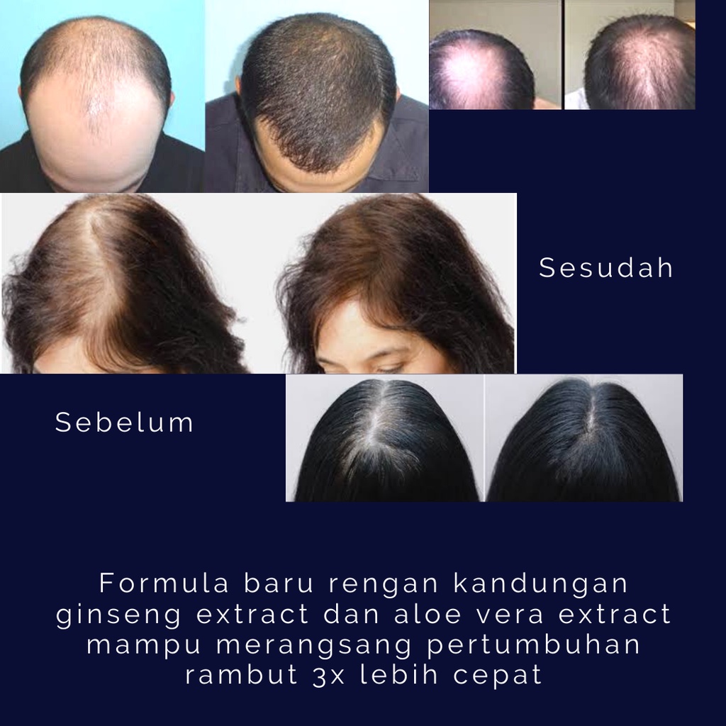 (Harga Grosir 40 Pcs) Hair Growth Serum Penumbuh Rambut Alami By Shevanna