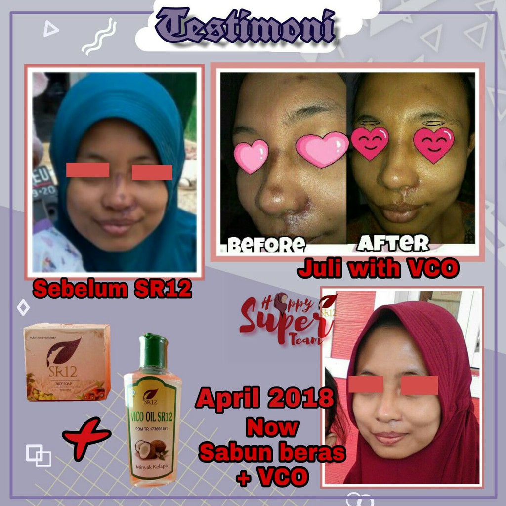 Minyak Kelapa Asli Vco Sr12 Untuk Kulit Penghilang Bekas Luka Jerawat Cacar Di Wajah Kering 60 Ml Indonesia