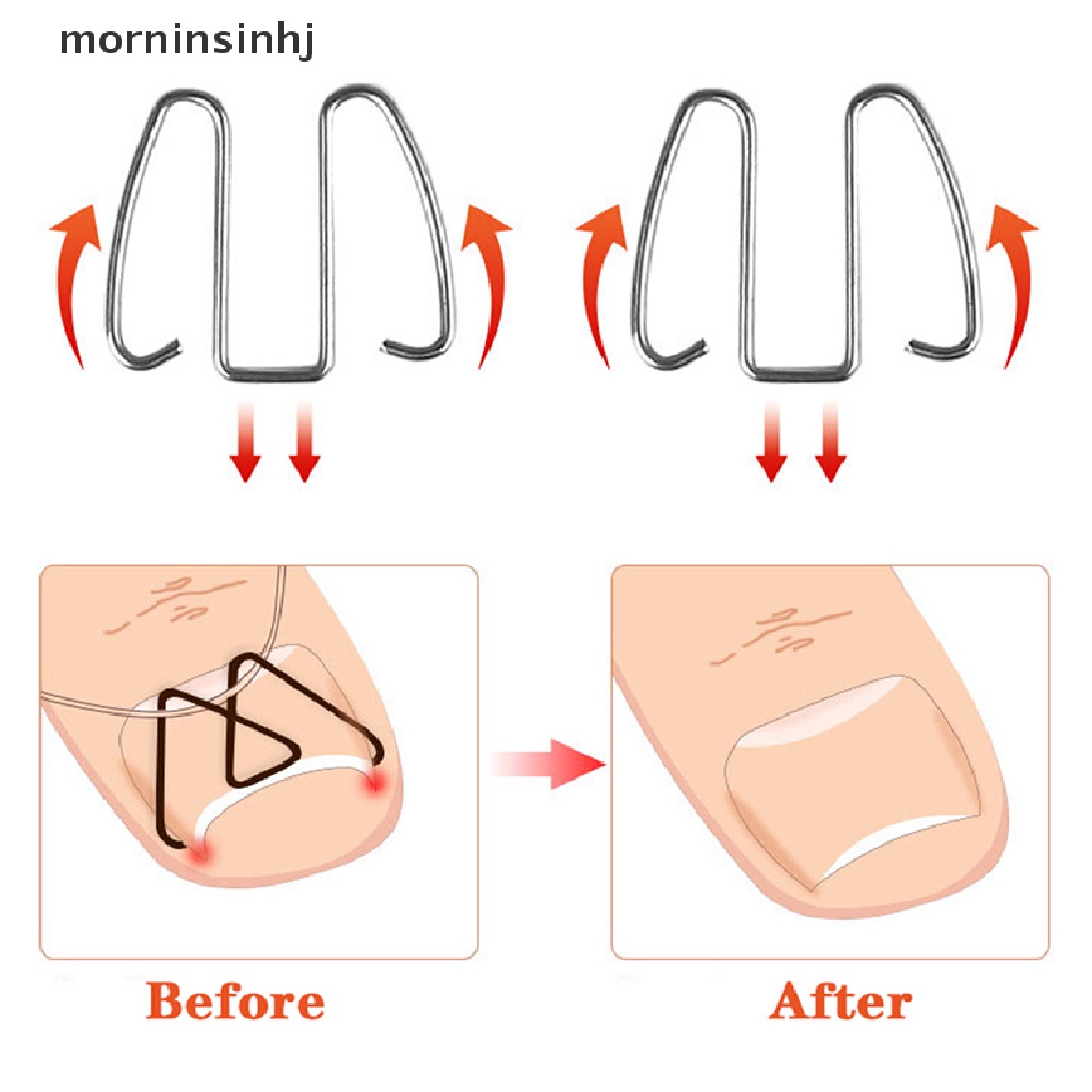 Mor Alat Koreksi Kuku Kaki Ingrown Paronychia