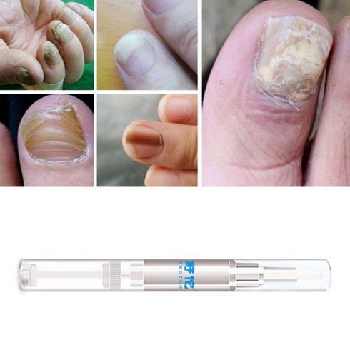 Serum Jamur Korea Kuli Pencil Cairan Obat Infeksi Anti Jamur Regenerasi Perawatan Kuku Kaki