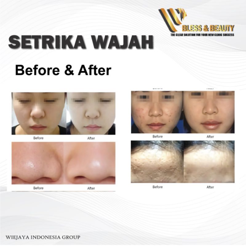 Alat Setrika Wajah Original Facelift Hot and Cold Face Lifting Anti Aging Menghilangkan Kerutan