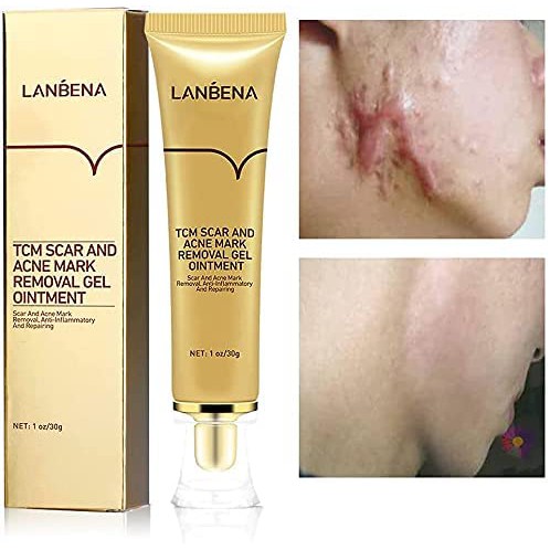 LANBENA TCM Scar and Acne Mark Removal Gel / Penghilang Bekas Oprasi , Jerawat dan Luka