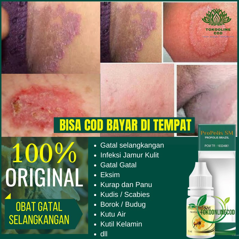 Obat Gatal Selangkangan, Infeksi Jamur Di Kemaluan Wanita / Pria, Kemerahan, Ruam Herbal Propolis SM