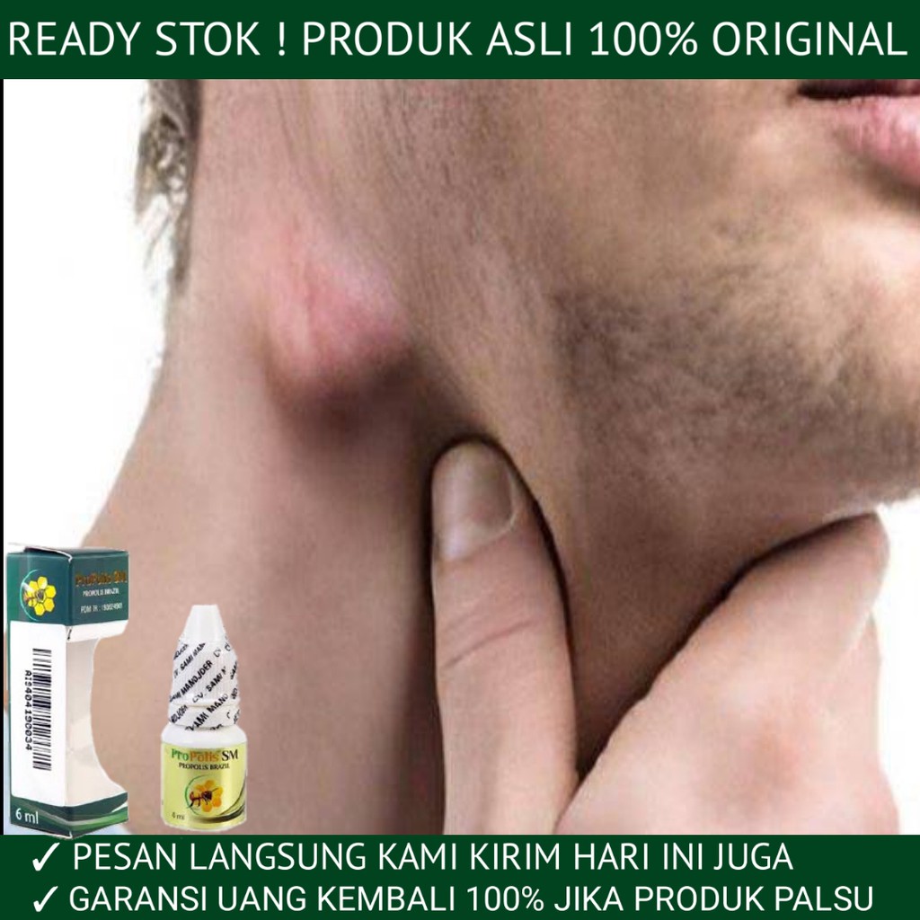 Obat Oles Pengempis Benjolan Lipoma Limfoma Kelenjar Getah Bening