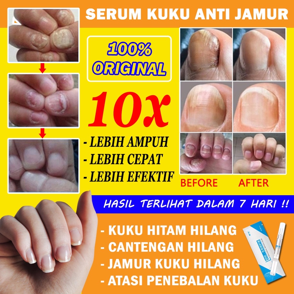 OBAT JAMUR KUKU SERUM KUKU OBAT KUKU CANTENGAN OBAT JAMUR KUKU OBAT KUKU RUSAK PEMBERSIH KUKU