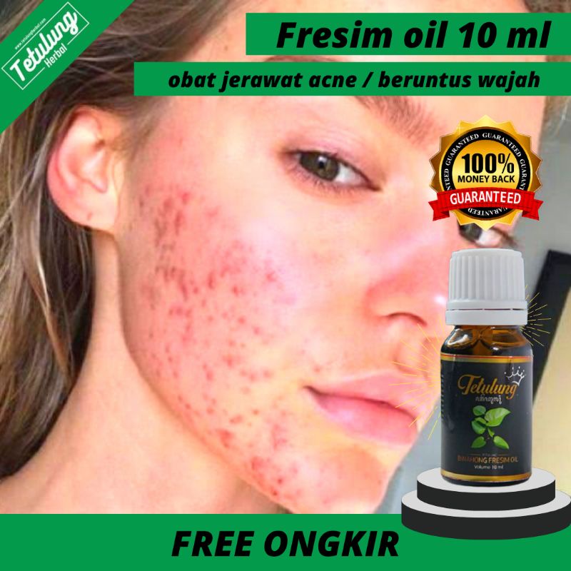 Tetulung Binahong Fresim Oil , Obat Jerawat Kronis Ampuh - Obat Penghilang Bekas Jerawat Hitam - Pen