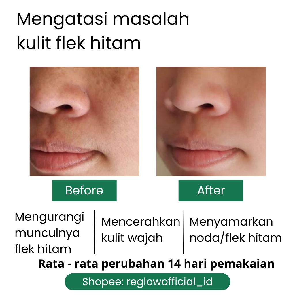 Reglow Skincare Original Official Store Perawatan Wajah Glowing Penghilang Flek Noda Hitam Bekas Jerawat Komedo Bruntusan Pori Pori Besar Pencerah Kulit Kusam Berminyak Re Glow Reg glow Beauty dr Shindy Putri