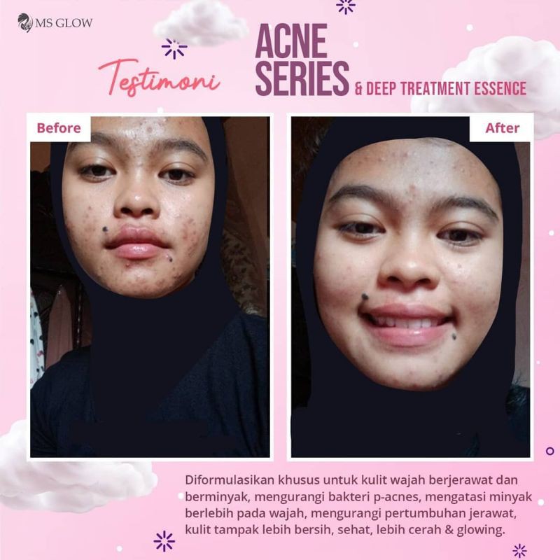 Ms Glow Paket Wajah 100% Original perawatan wajah,  skincare(bisa cod)