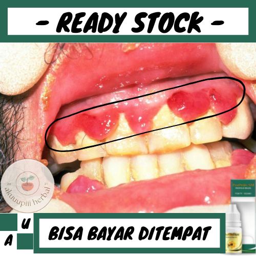 Obat Penyakit Scorbut, Obat Gusi Bengkak, Obat Gusi Berdarah, Mati Rasa, Sakit Gusi - Propolis SM