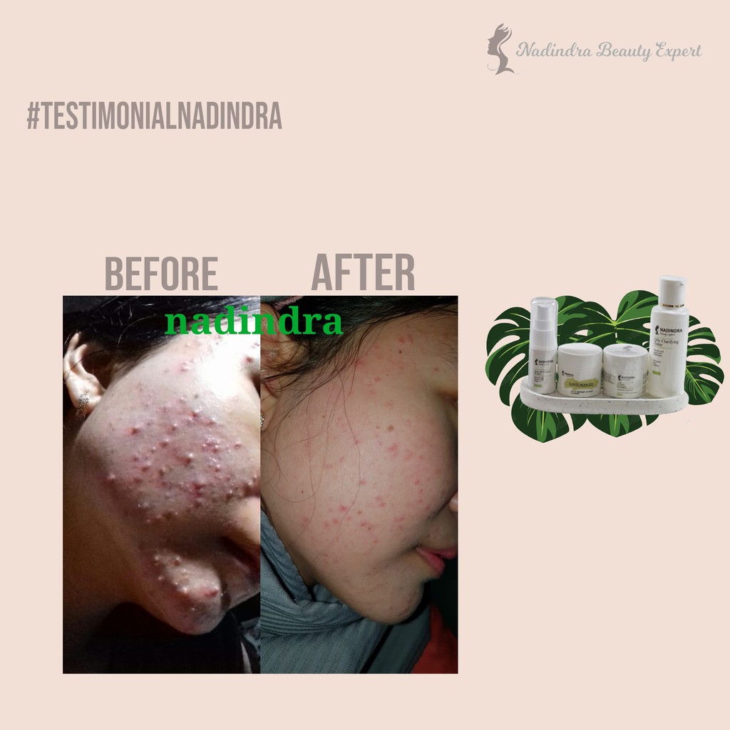 Nadindra Beauty Expert paket Pre Treatment Acne - step 1 / netralisir efek samping skincare keras-3