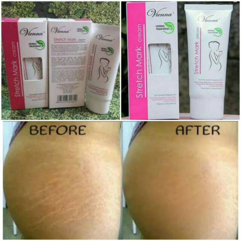 PENGHILANG STRECHMARK AMPUH PERMANEN BPOM 3 STRETCH MARK CREAM KRIM OBAT SALEP ORIGINAL