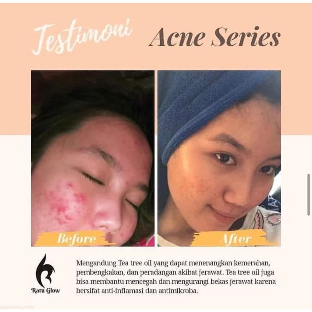 Ratu Glow Paket Skincare Kecantikan Perawatan Pembersih Penghilang Jerawat Kulit Wajah Anti Acne Kusam Komedo Berminyak Kulit Flek Hitam Skicare Bpom Original ACNE WHITENING